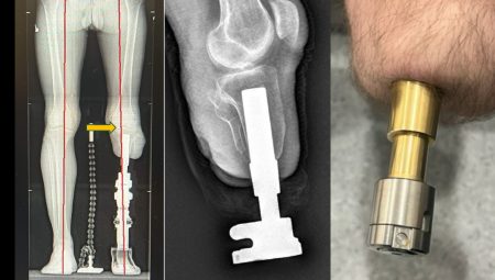 Protez kullananlara umut olan osseointegrasyon usulü